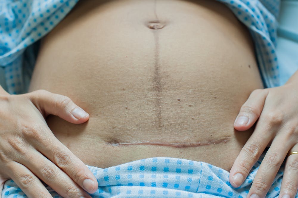 C-Section Scars: Types, Healing Stages and Care Tips