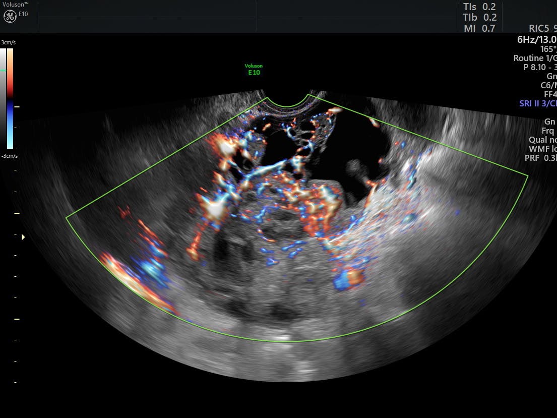 Evaluating Ovarian Mass Symptoms with Ultrasound ...