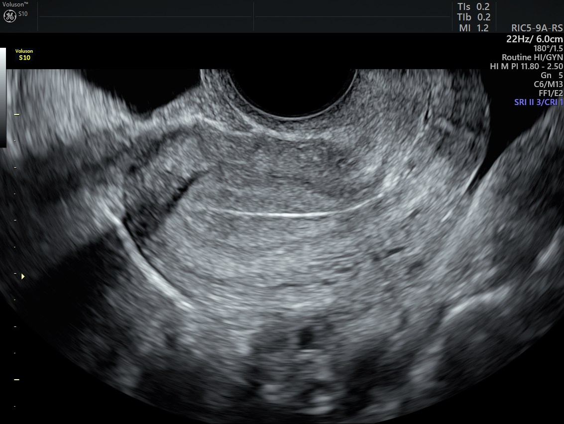 Common Perimenopause Symptoms Ultrasound Diagnosis Empowered Women