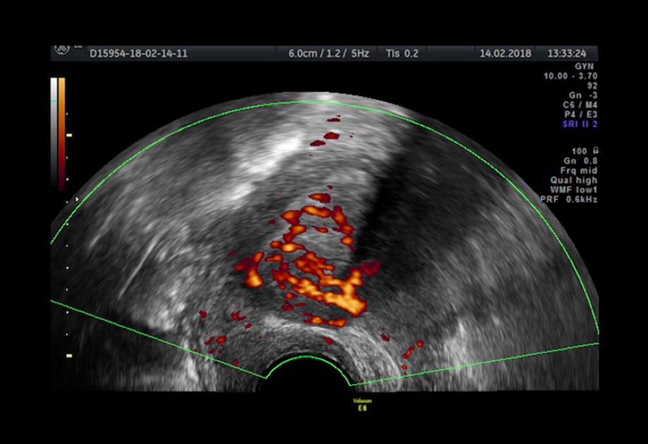 ovarian cancer or endometriosis