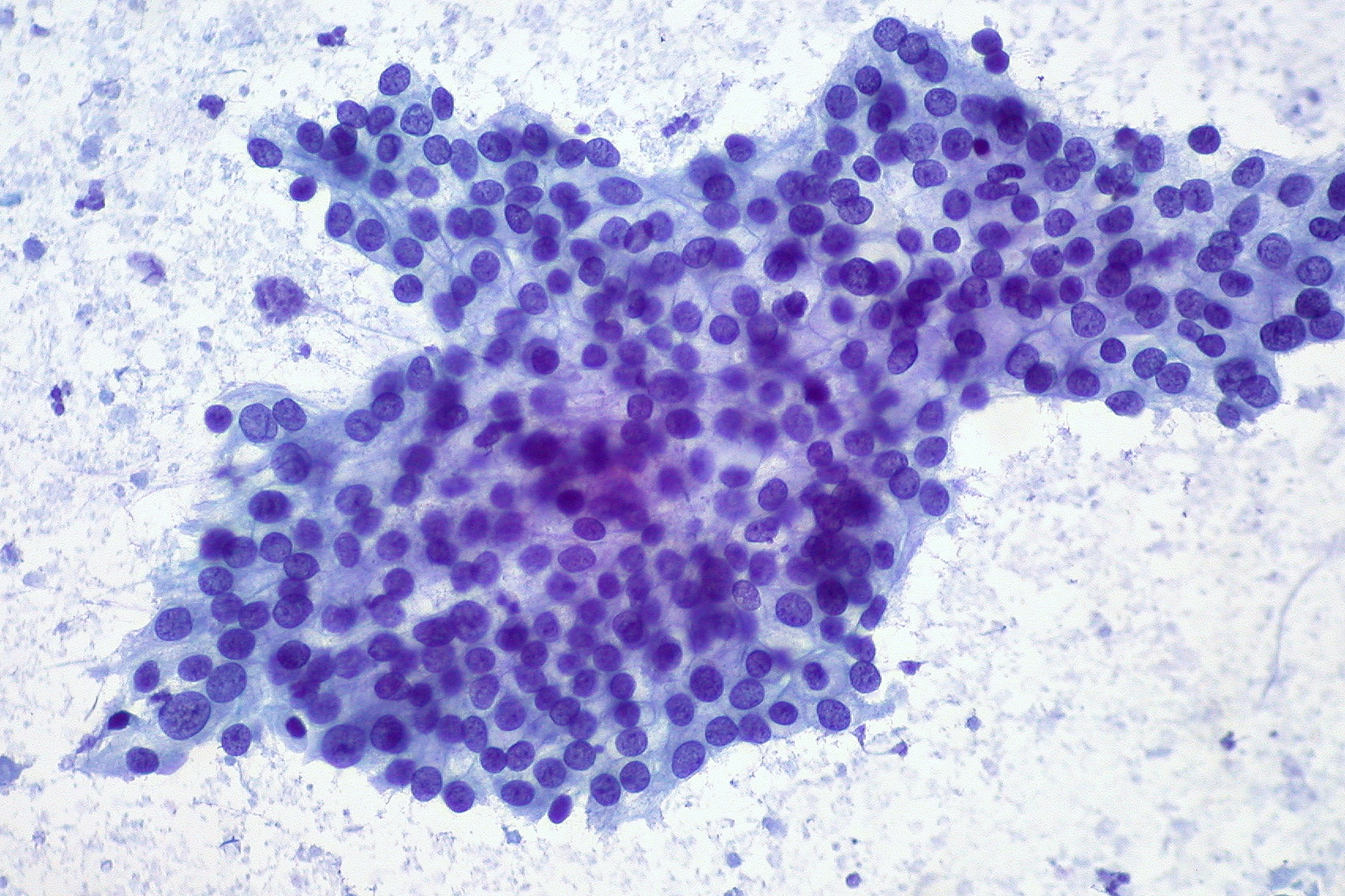 Adenocarcinoma of the pancreas. The dark purple circles in the center are the nuclei of cancer cells (e.g. a tumor)