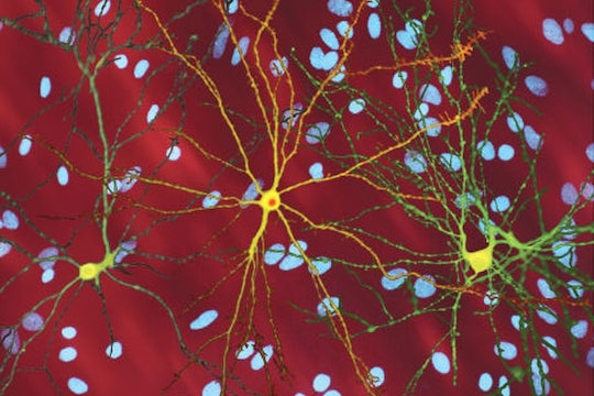 A montage of three images of single striatal neurons transfected with a disease-associated version of huntingtin, the protein that causes Huntington's disease. Nuclei of untransfected neurons are seen in the background (blue). The neuron in the center (yellow) contains an abnormal intracellular accumulation of huntingtin called an inclusion body (orange).