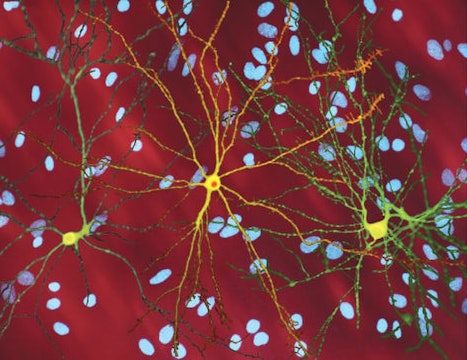 A montage of three images of single striatal neurons transfected with a disease-associated version of huntingtin, the protein that causes Huntington's disease. Nuclei of untransfected neurons are seen in the background (blue). The neuron in the center (yellow) contains an abnormal intracellular accumulation of huntingtin called an inclusion body (orange).