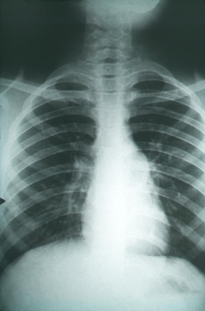 X-ray of lungs from a patient with coccidioidomycosis, Valley Fever. 
