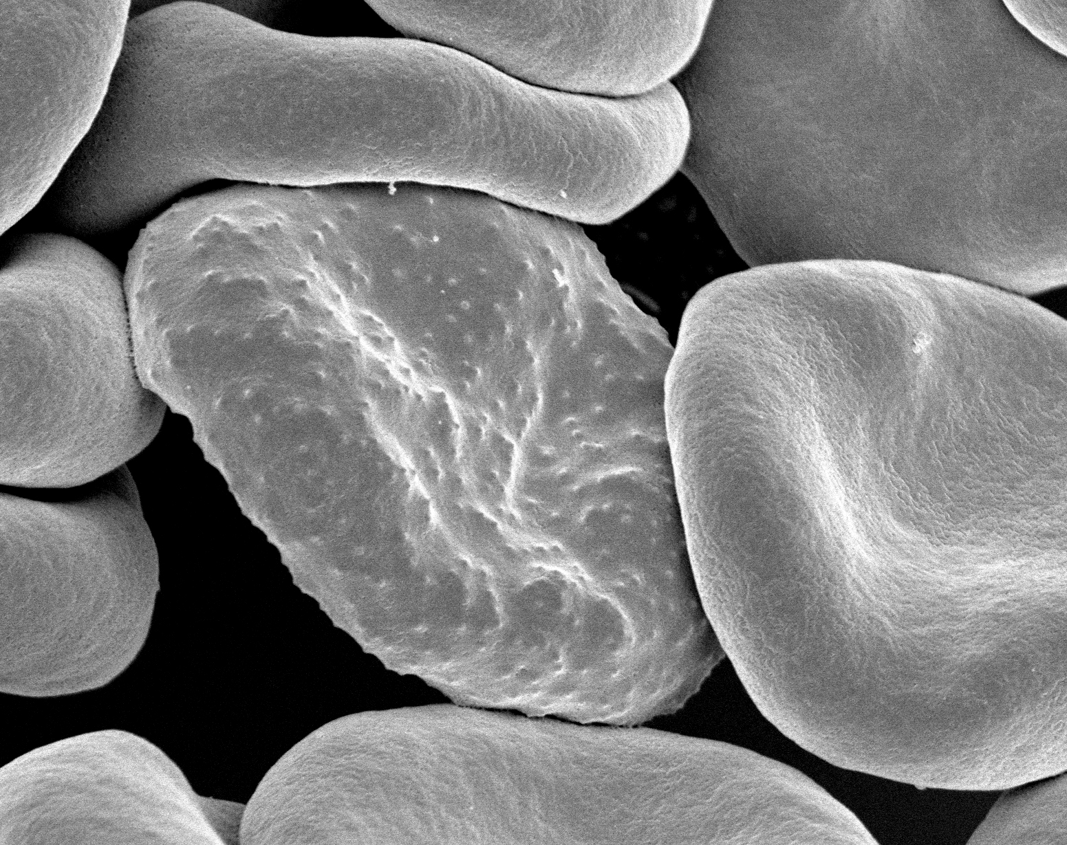 Red blood cells infected with Plasmodium falciparum, the parasite that causes malaria in humans. During its development, the parasite forms protrusions called 'knobs' on the surface of its host red blood cell which enable it to avoid destruction and cause inflammation. 