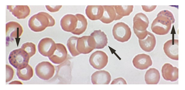 Red blood cells damaged by lead exposure