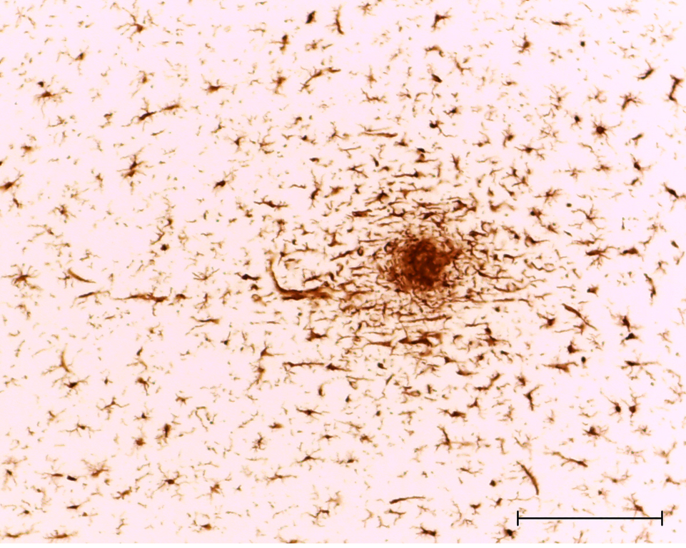  Microgliacytes in rats cortex migrate to inflamation point after experimental ischemic stroke. Cells are activated what we can see by round form of their bodies and lack of processes. That means cells are show phagocytic activity. This is rapid and nesessary reaction of microglial cells to stop cytotoxic activity of damaged neuronal cells. The scale bar is 50 microns.