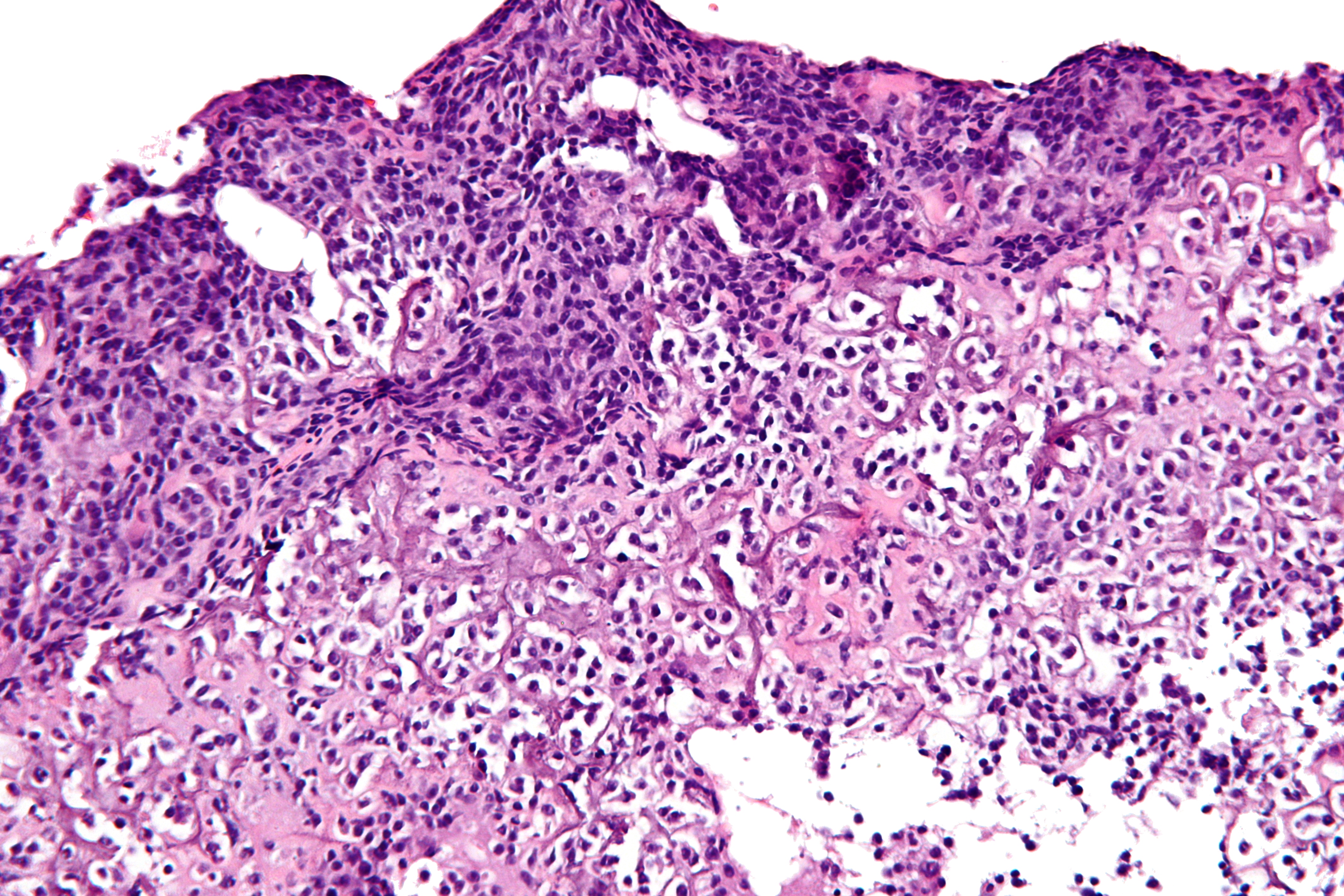 A section of bone with osteosarcoma, a type of bone cancer.