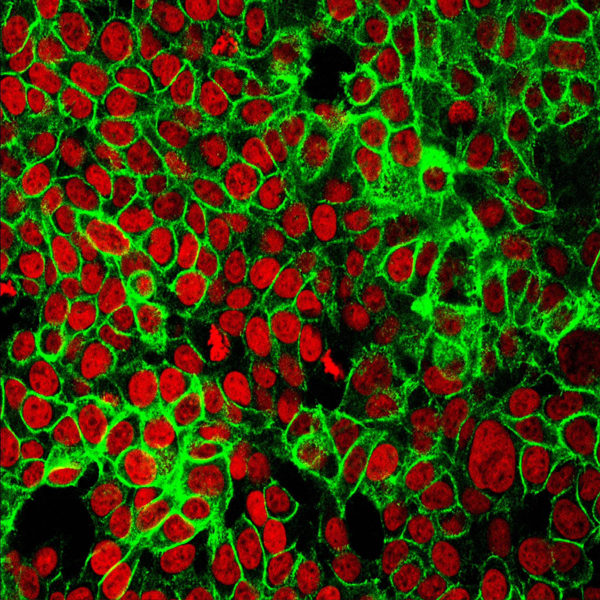 red and green stained photograph of human colon cancer cells