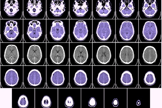 series of CT scans of brain and skull, some purple