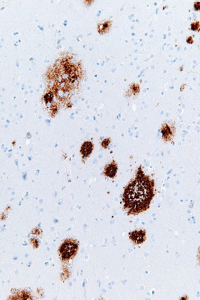 Plaques (brown) in the brain of a Alzheimer's disease patient