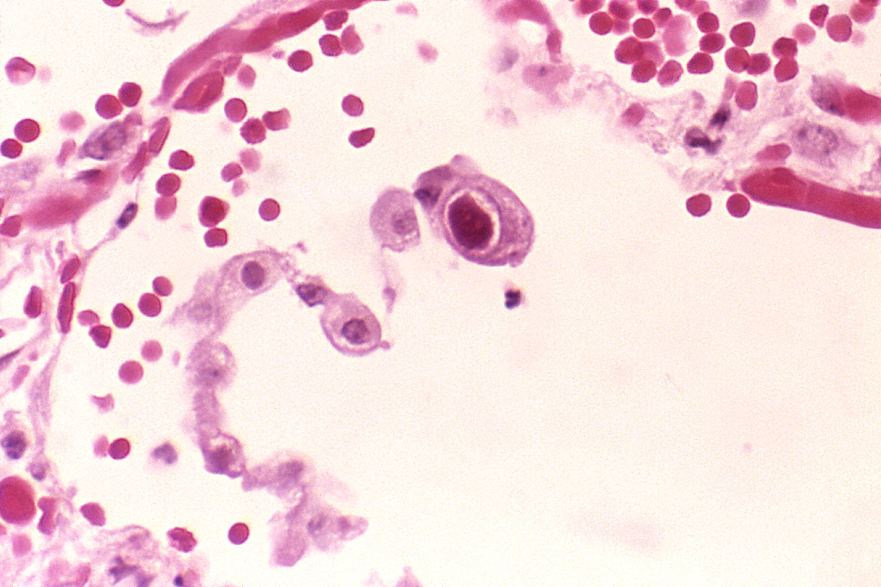 Pneumocytes (a type of cell in the lungs) infected with CMV. The central cell displays the dramatically enlarged nuclei characteristic of CMV