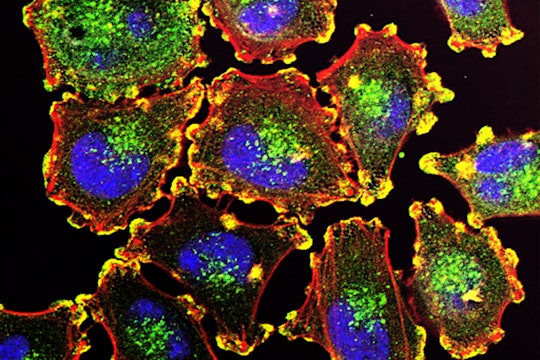 metastatic melanoma cancer cells