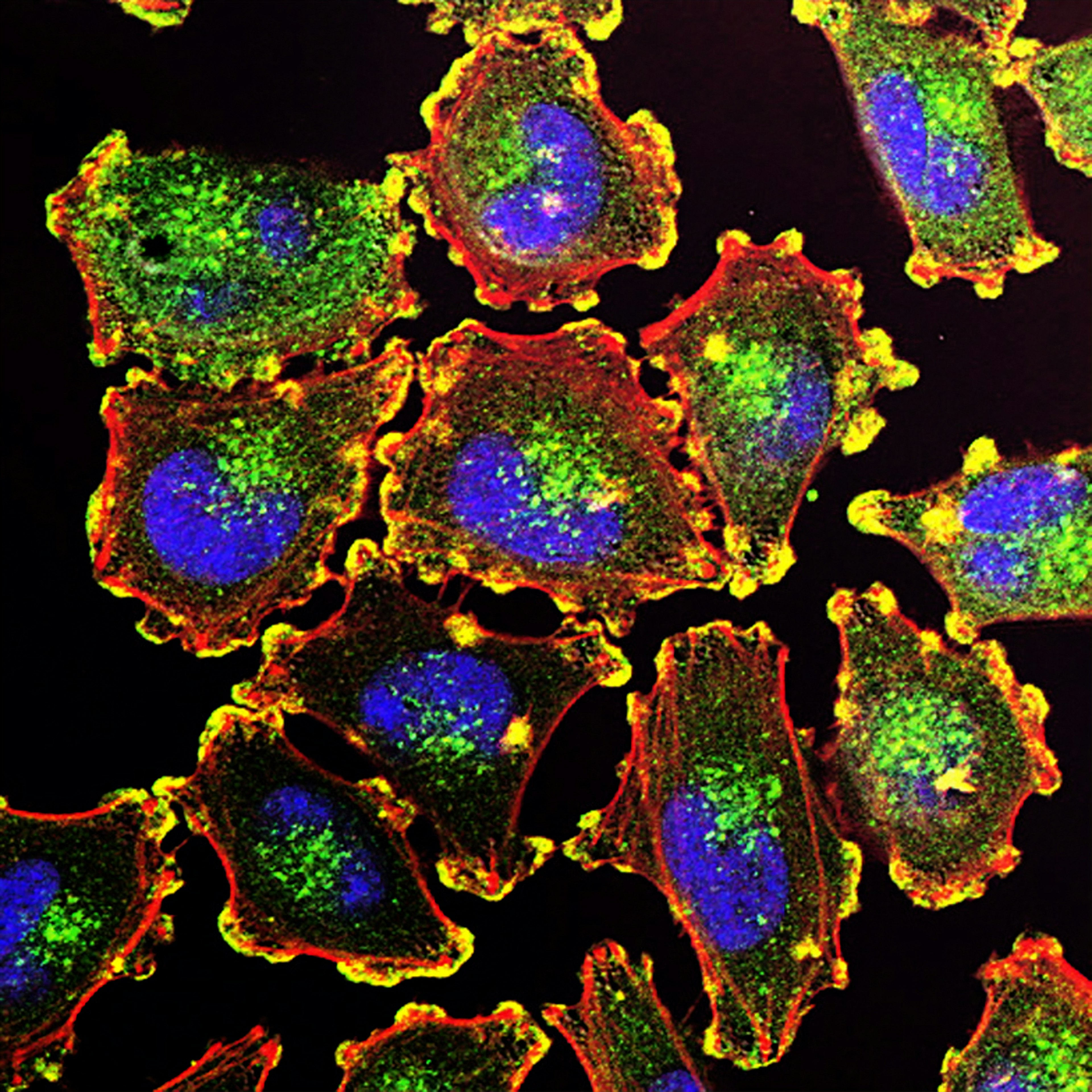 metastatic melanoma cancer cells