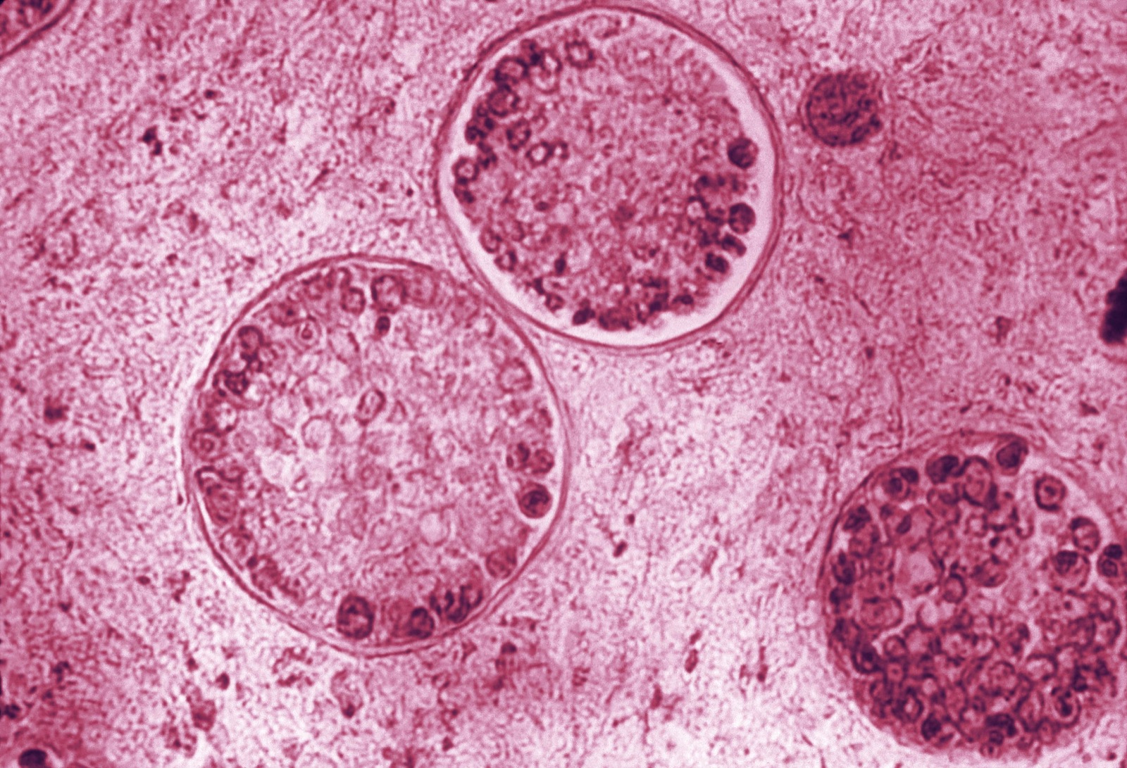 This photomicrograph reveals the spherules of one of the species of Valley Fever fungus, Coccidioides immitis. Within these spherules, you can see the spores.