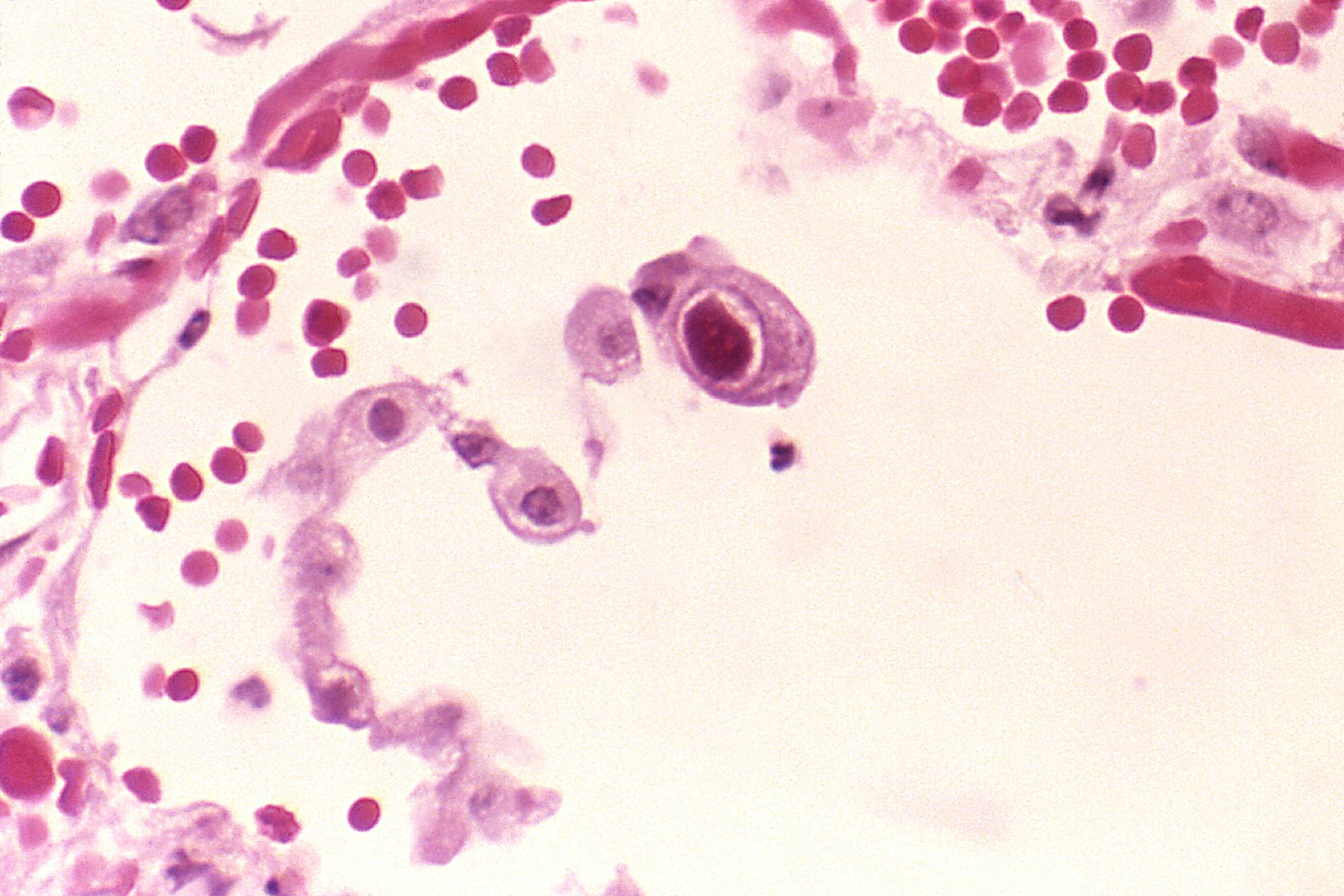 Lung tissue with a HCMV infection