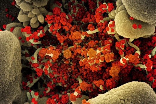 Colorized scanning electron micrograph of an apoptotic cell heavily infected with SARS-COV-2, isolated from a patient sample.
