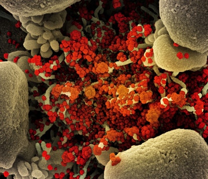 Colorized scanning electron micrograph of an apoptotic cell heavily infected with SARS-COV-2, isolated from a patient sample.