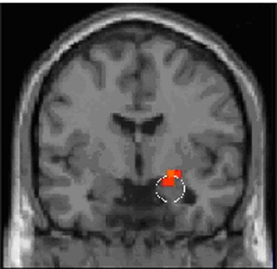 A brain scan highlighting the amygdala.