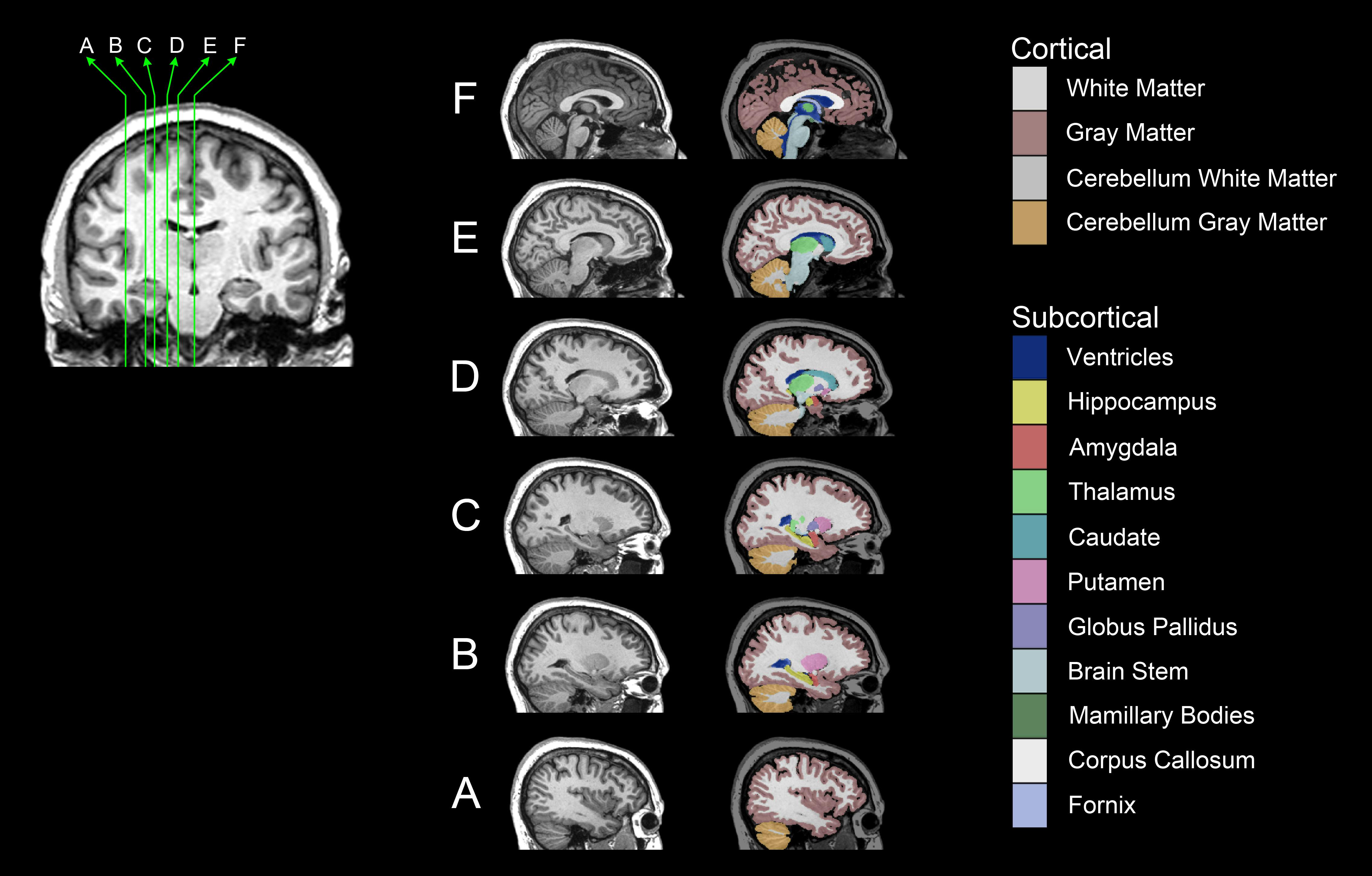 Exploring How Brains Grow Could Help Us Understand Autism