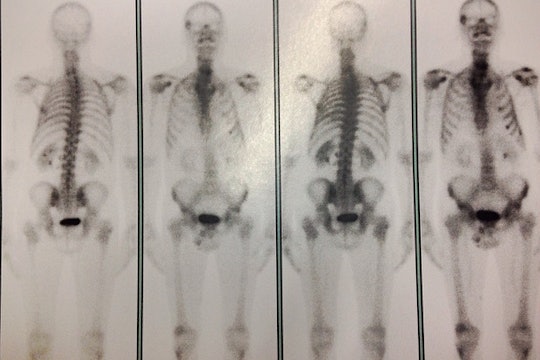 Cancer X-rays of different skeletons with cancerous growth visible.