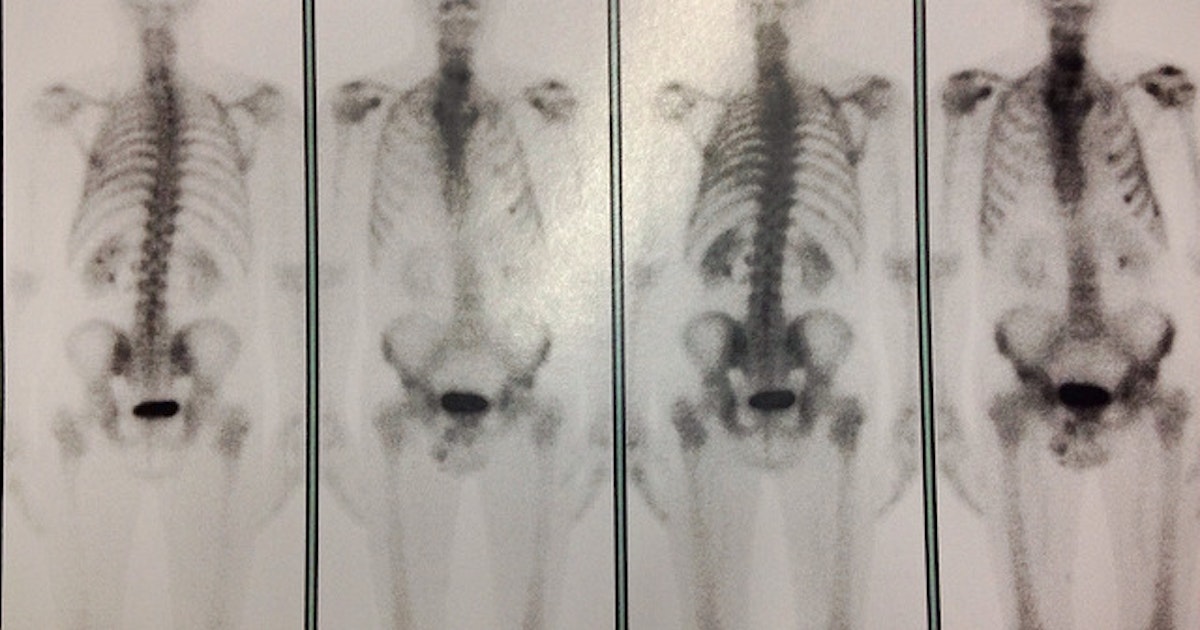 We can detect and treat it better than ever, but preventing cancer is