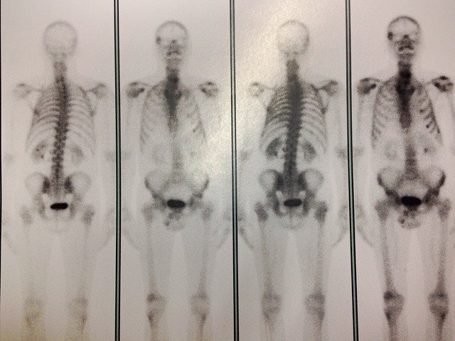 X-rays of different skeletons with cancerous growth visible.
