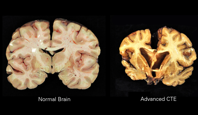 Symptoms of CTE don't appear until years or decades after chronic impacts.