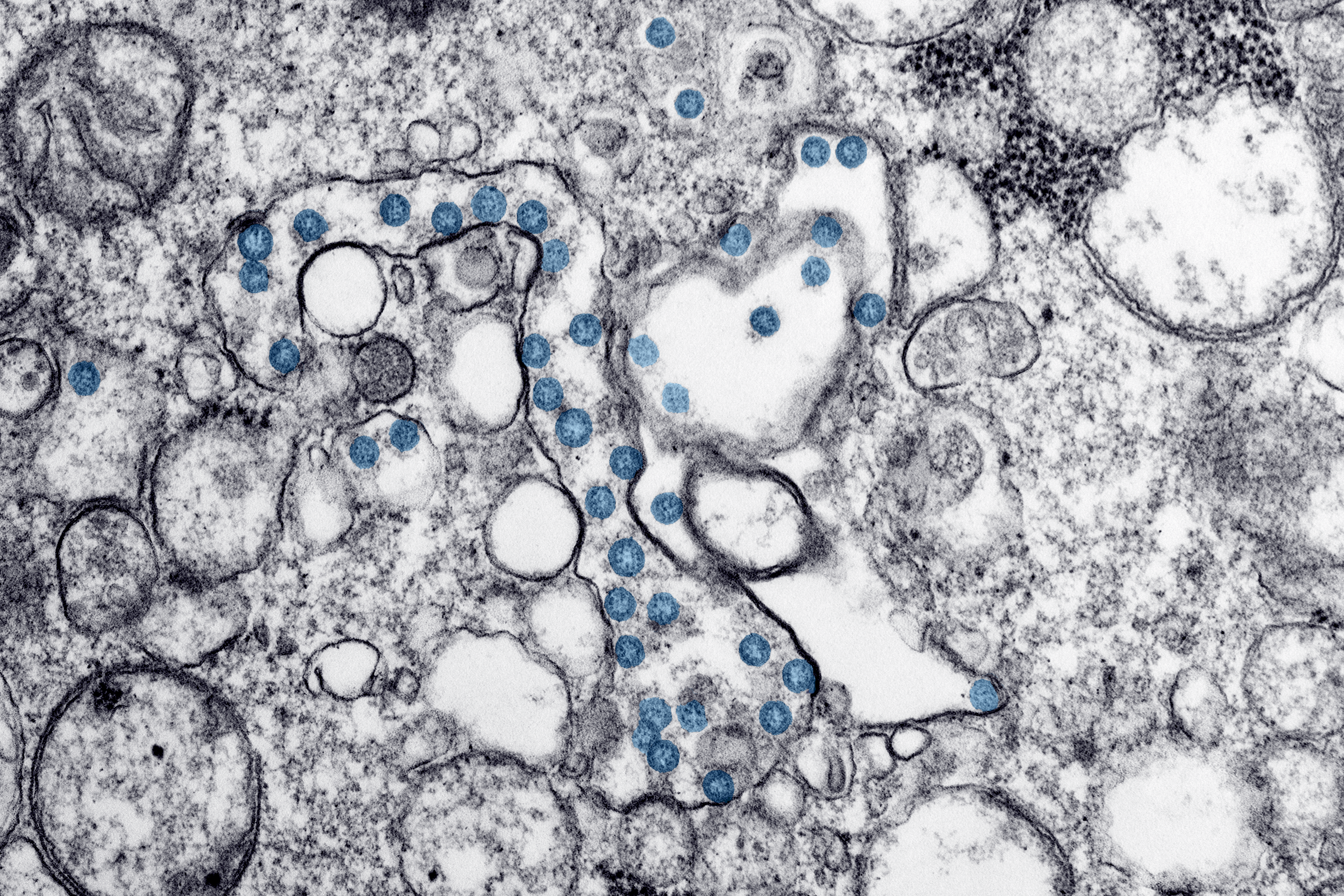 A transmission electron microscopic image of coronavirus particles, colored blue, in a patient sample. The virus's genetic material can be seen as little black dots within the blue particles.