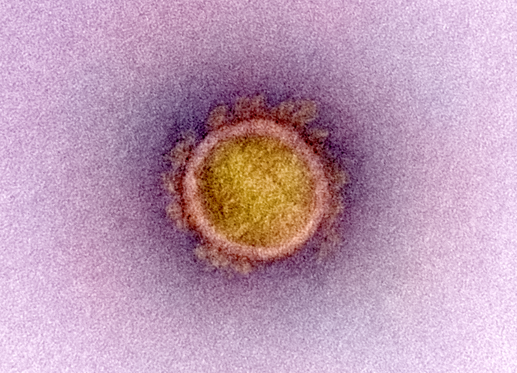 A single coronavirus particle, false colored yellow with a pink membrane, surrounded by "crown" proteins.