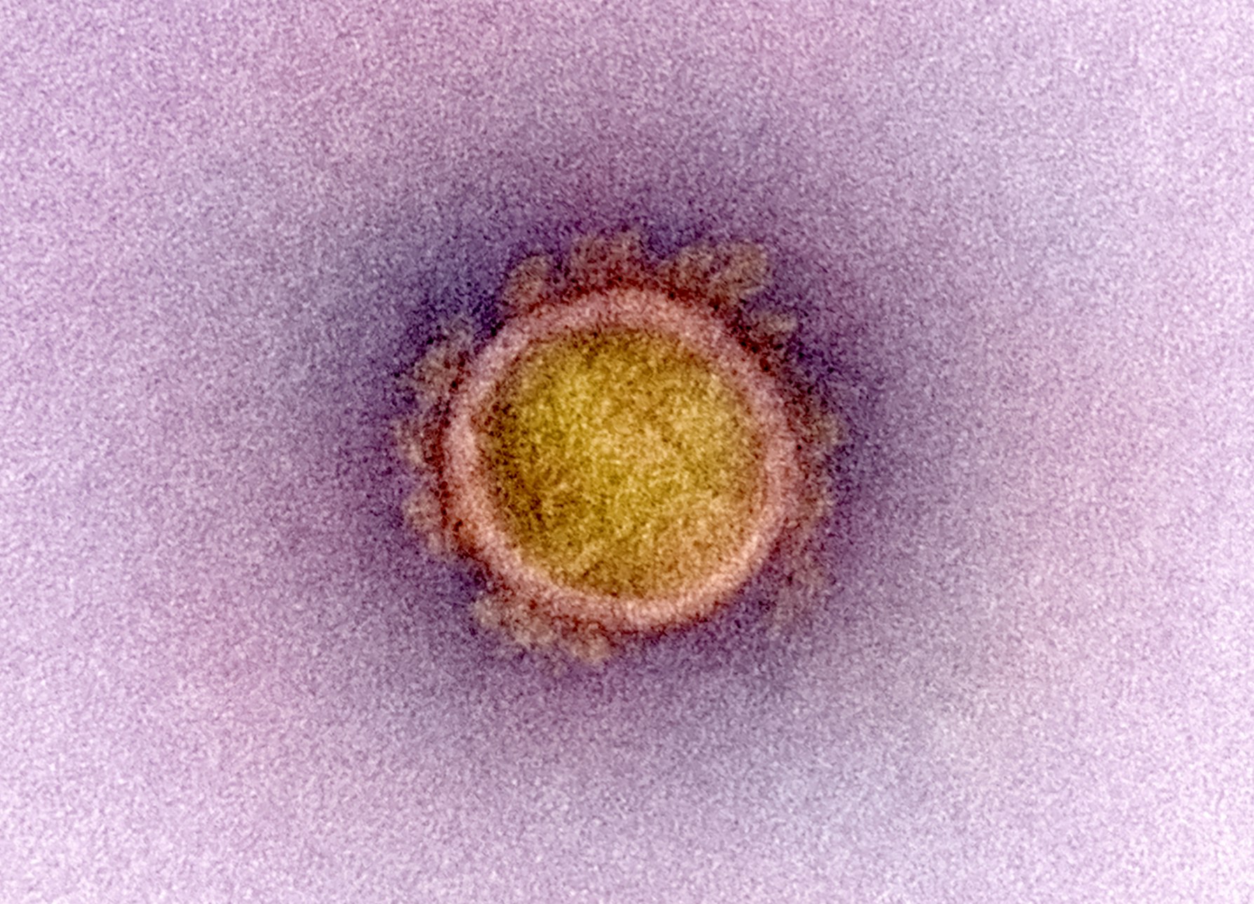 A single coronavirus particle, false colored yellow with a pink membrane, surrounded by "crown" proteins.