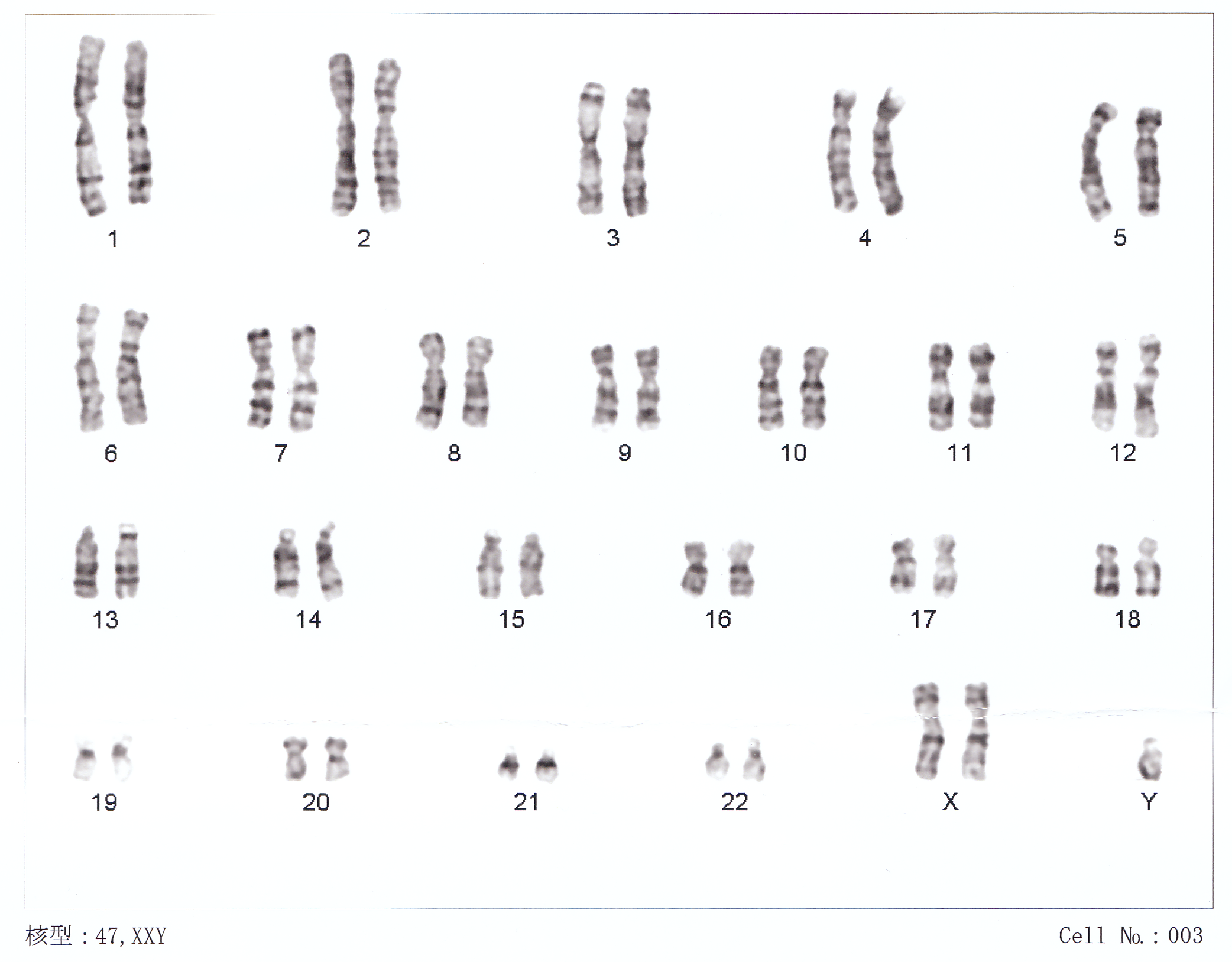 The chromosomes of a person with XXY, often called Klinefelter syndrome