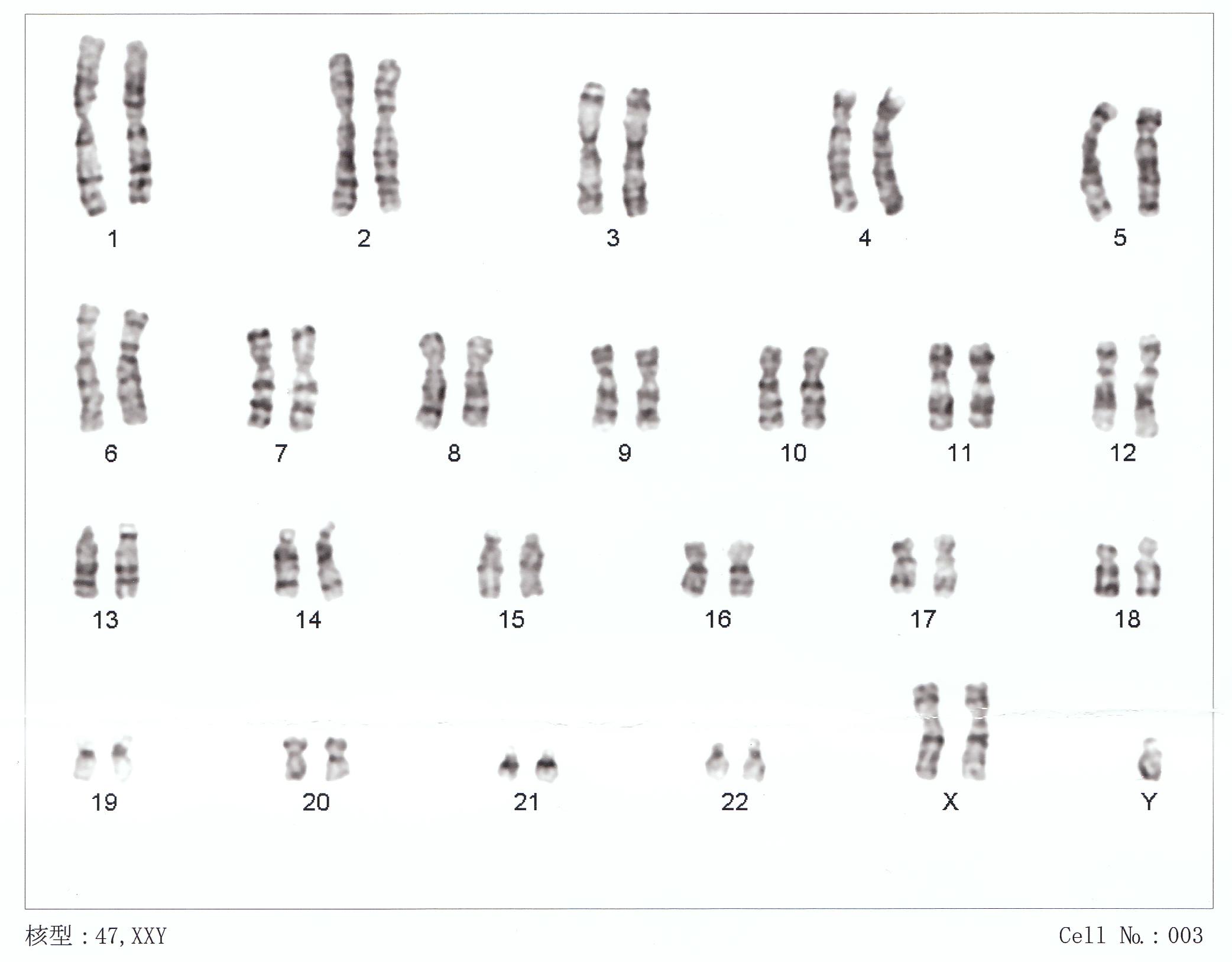The chromosomes of a person with XXY, often called Klinefelter syndrome Photo: Wikimedia Commons