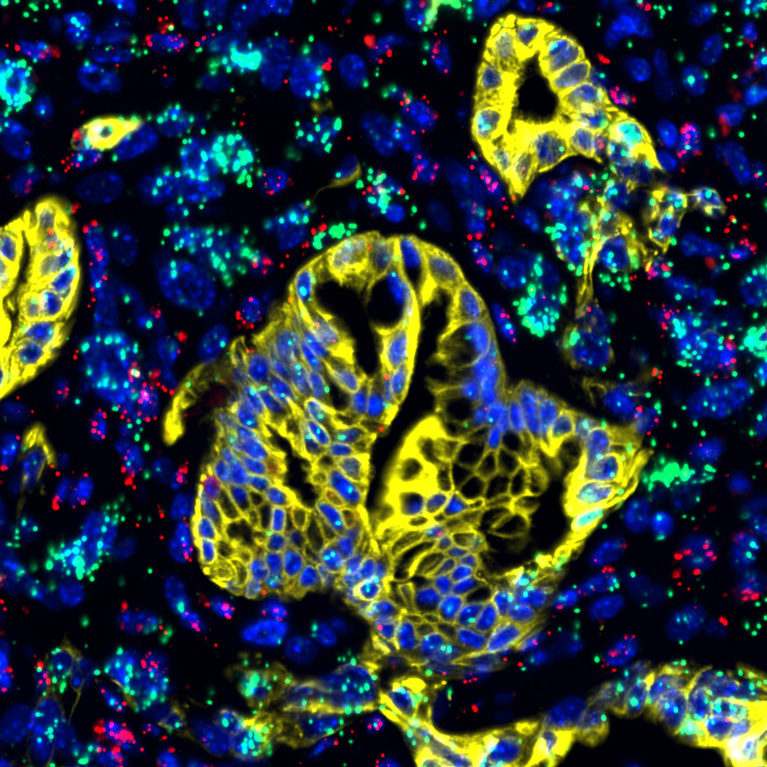 A stained picture of healthy pancreatic cells alongside pancreatic cancer cells.