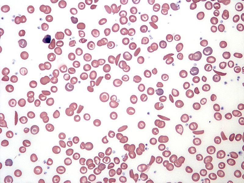 sickle cell blood cells under the microscope against a white background