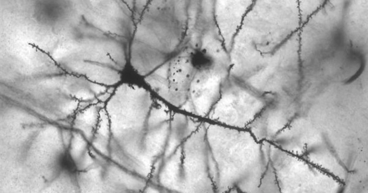 Neural Overactivity Overactive neurons may explain why some people develop stress-induced ...