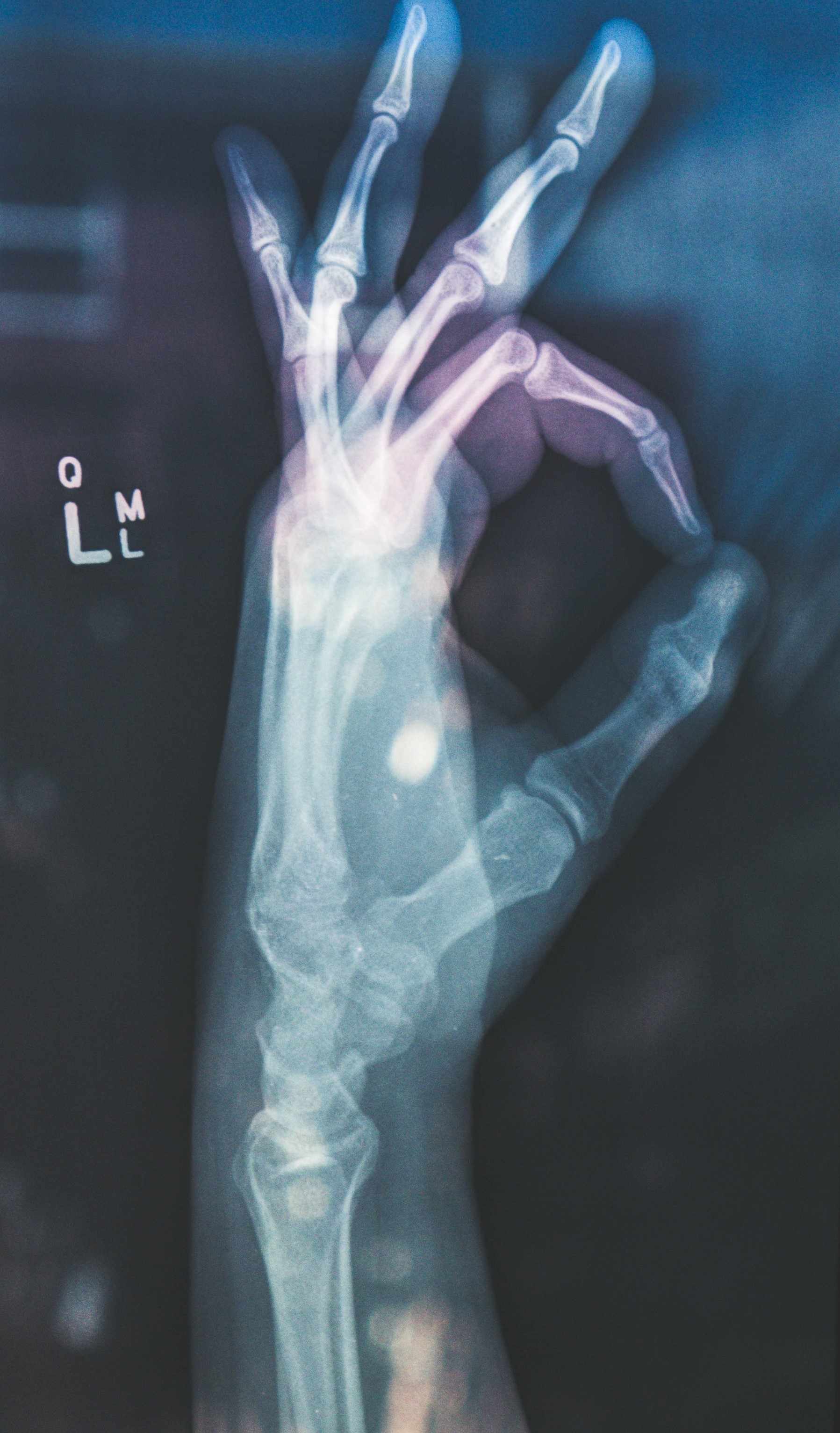 X-rayed hands showing the "OK" sign