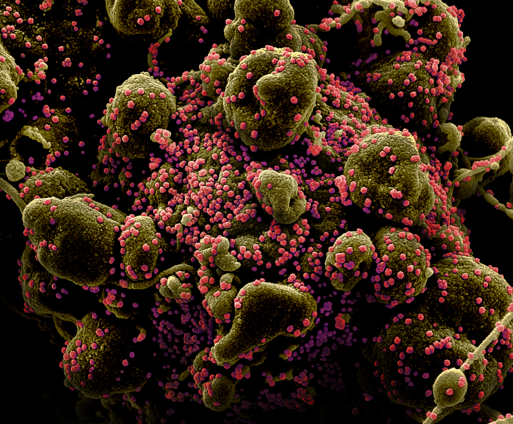 A scanning electron micrograph picture of SARS-CoV-2, the novel coronavirus, particles on the surface of a human cell undergoing apoptosis.