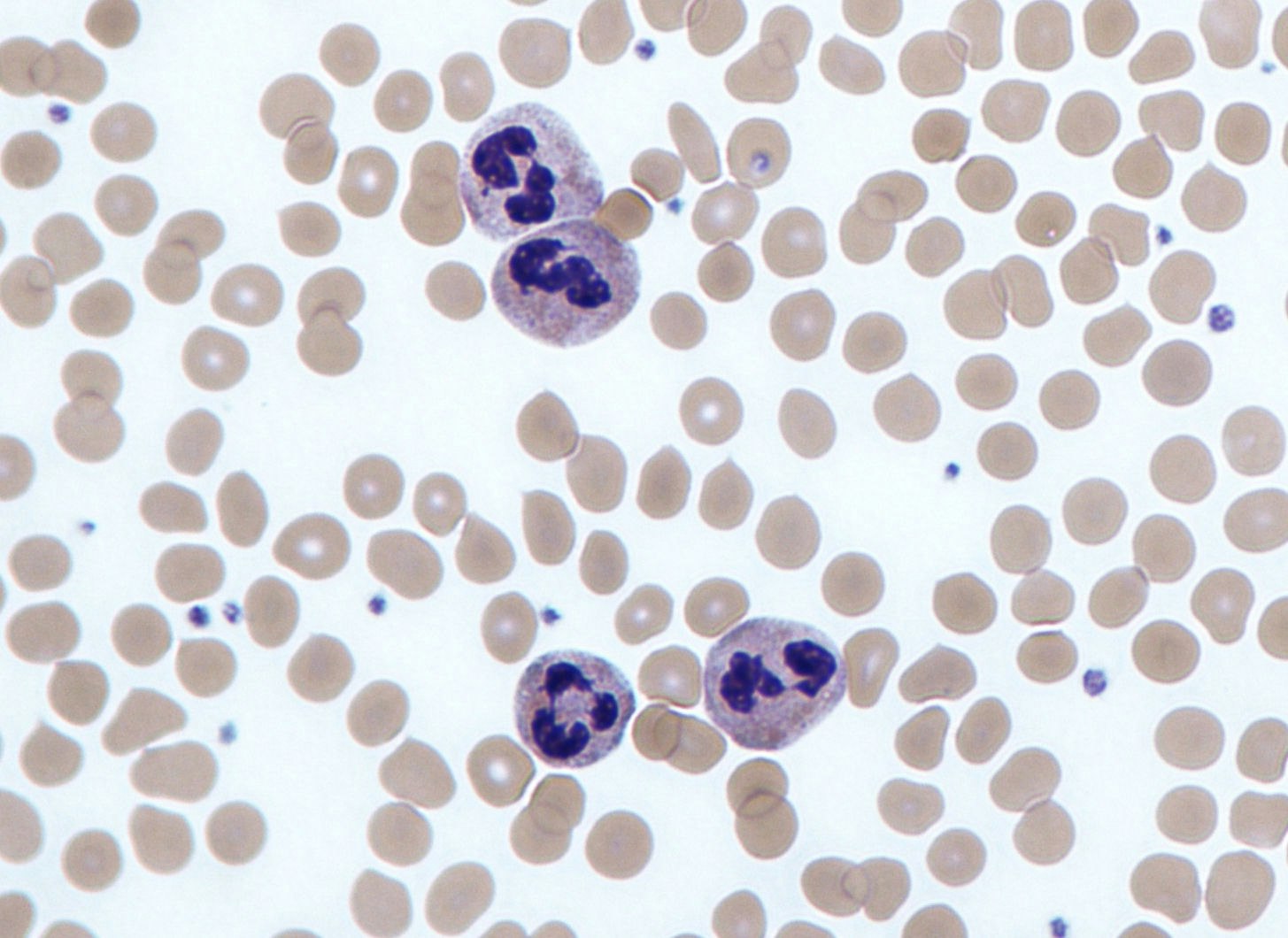 Red blood cells and purple neutrophils, a type of immune cell