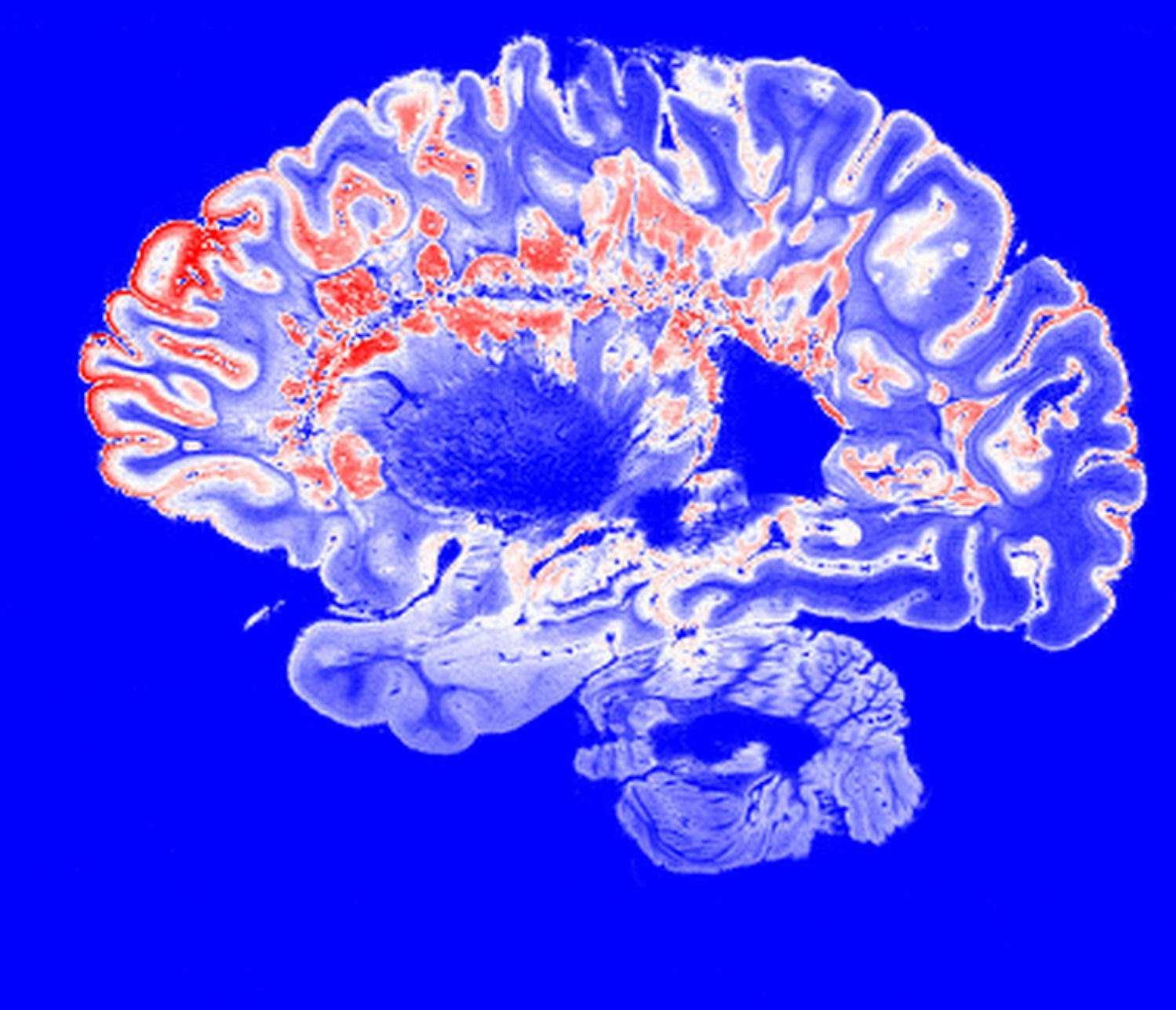 MRI scan of a brain