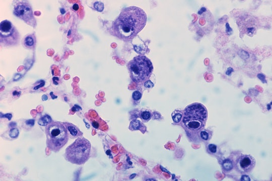 Basophils that have been infected with cytomegalovirus (CMV)