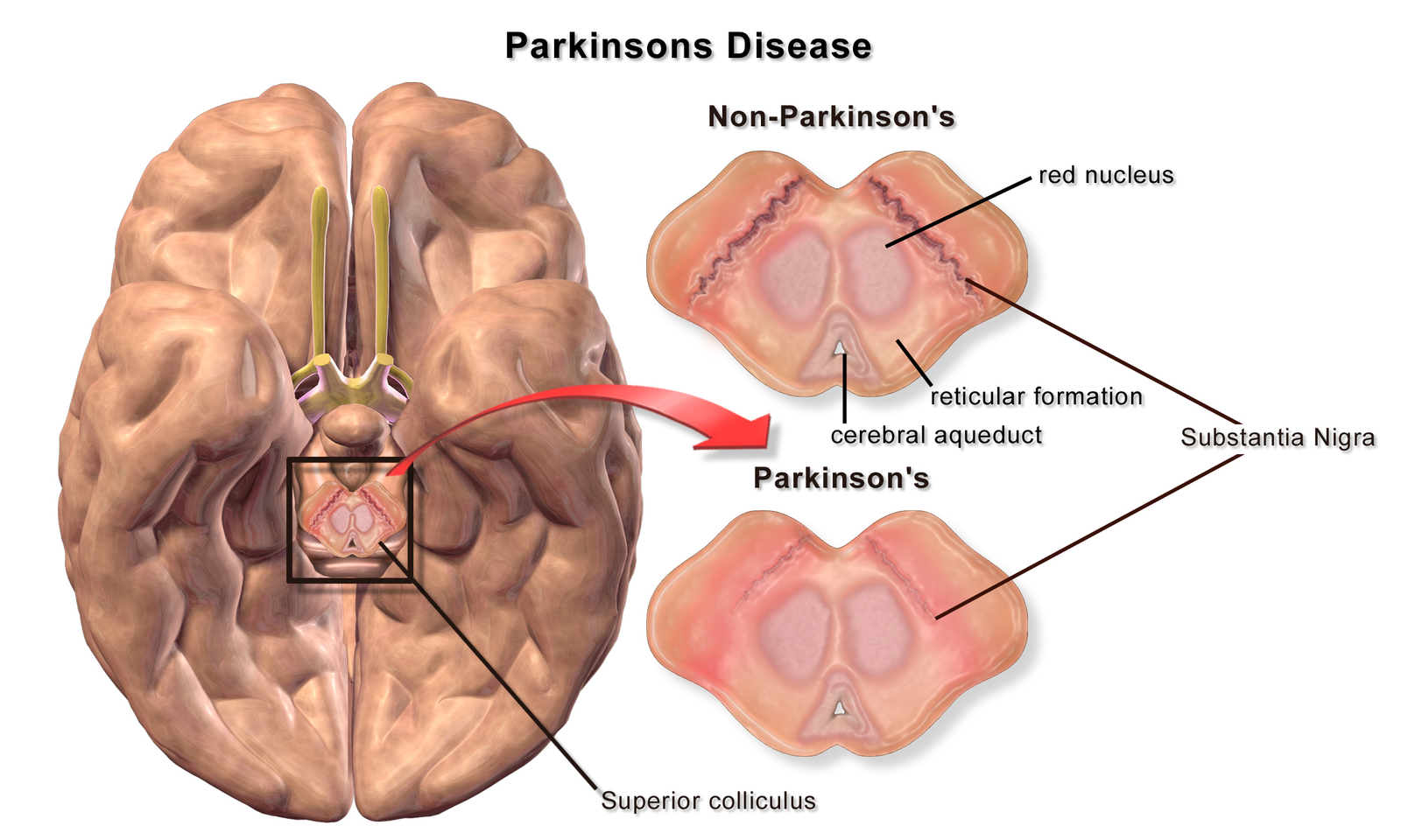 A bottom-up diagram of a brain of a patient with Parkinson's disease illustrating loss of pigmented cells in the Substantia nigra