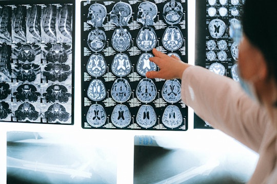 A doctor pointing at a series of brain scans