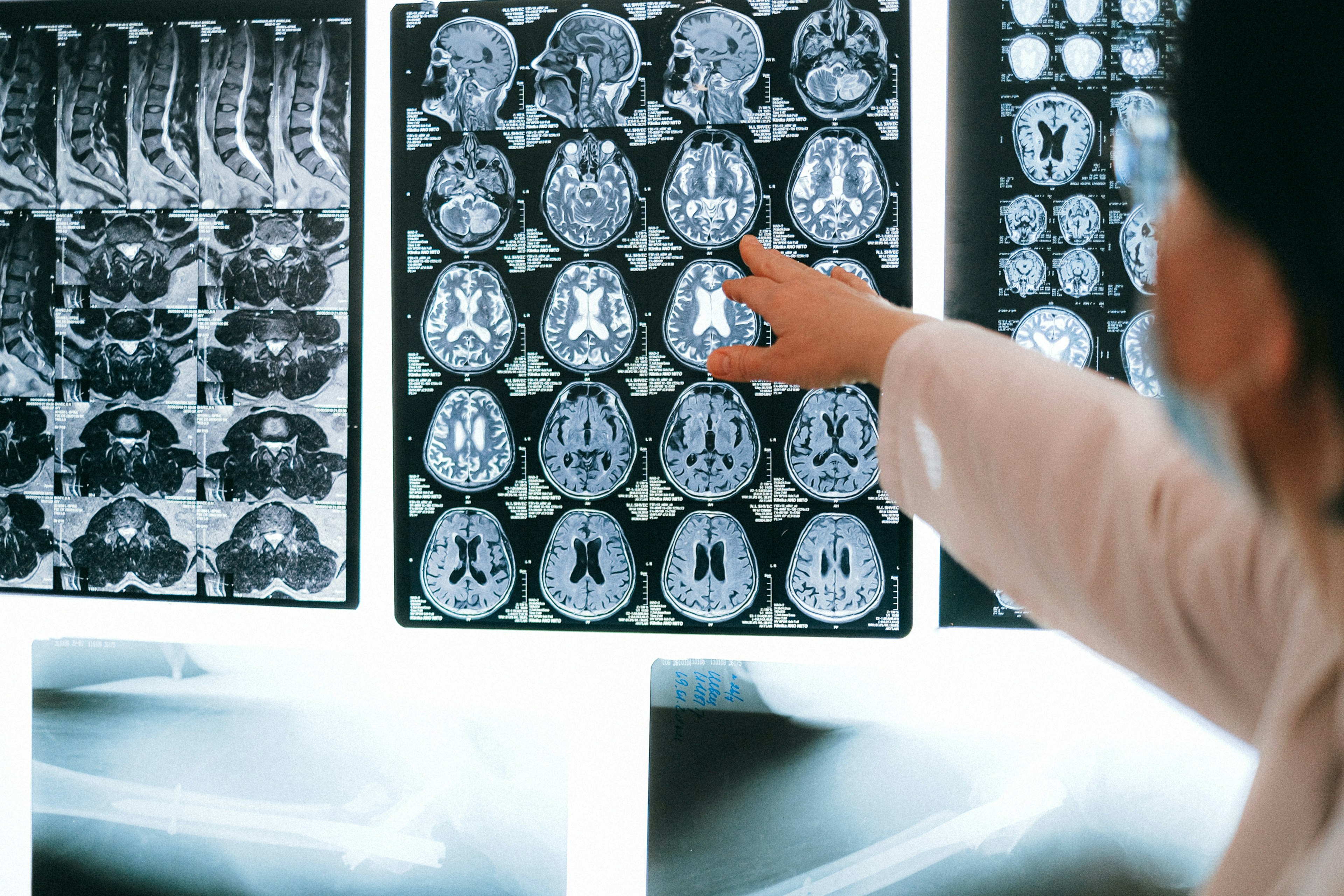 A doctor pointing at a series of brain scans