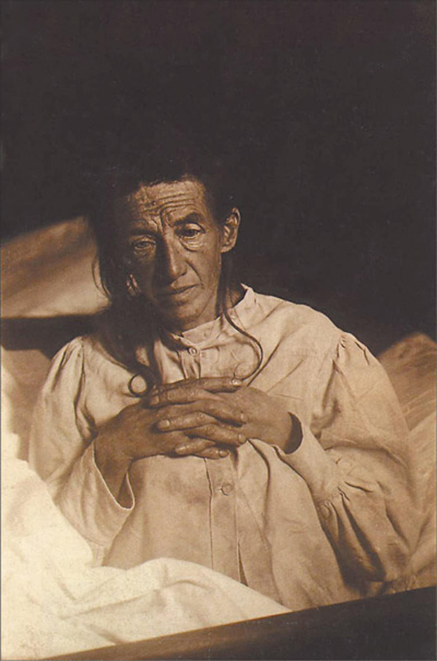 Auguste Deter, Alois Alzheimer's patient in November 1901, first described patient with Alzheimer's Disease. 