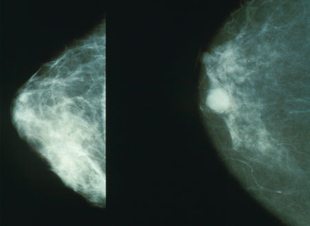 mammogram  cross section