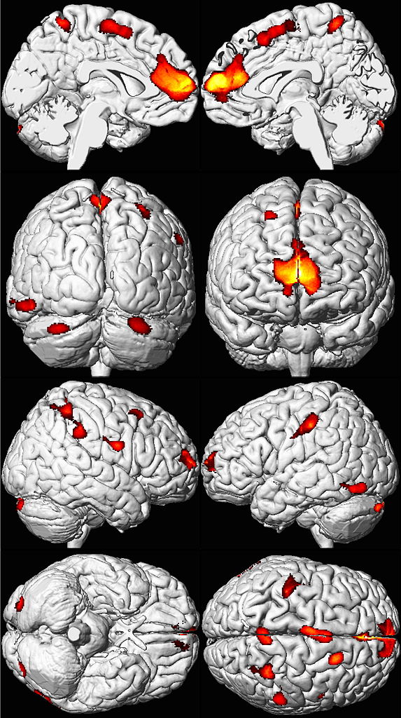 Decreased Brain Volume from Lead Exposure - areas highlighted in red and yellows are regions when people exposed to lead in childhood show reduced brain volume 
